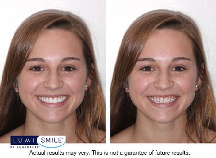 LumiSmile
