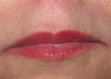 After Juvederm Upper Lip Injection