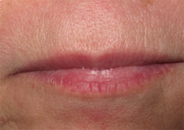 Before Juvederm Filler Lip Injection