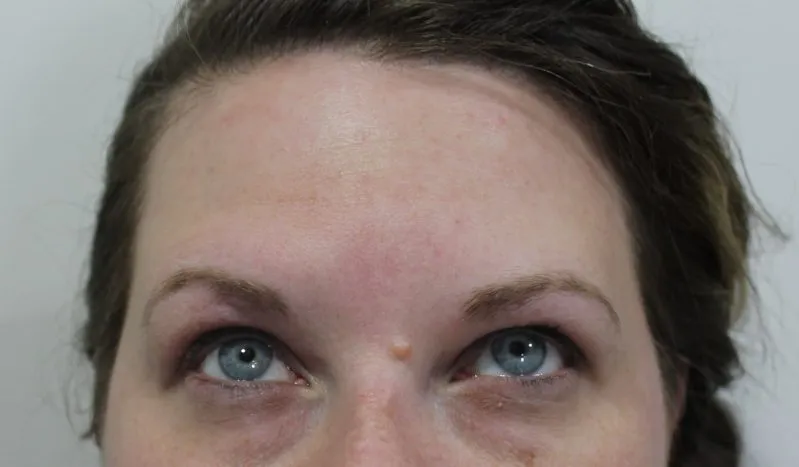 Botox & Juvederm example