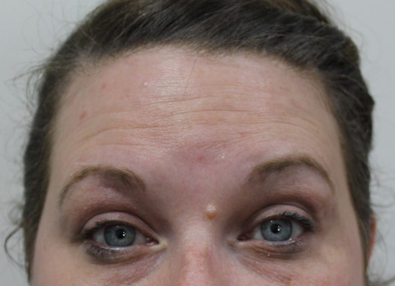 Botox & Juvederm example