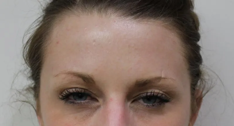 Botox & Juvederm example