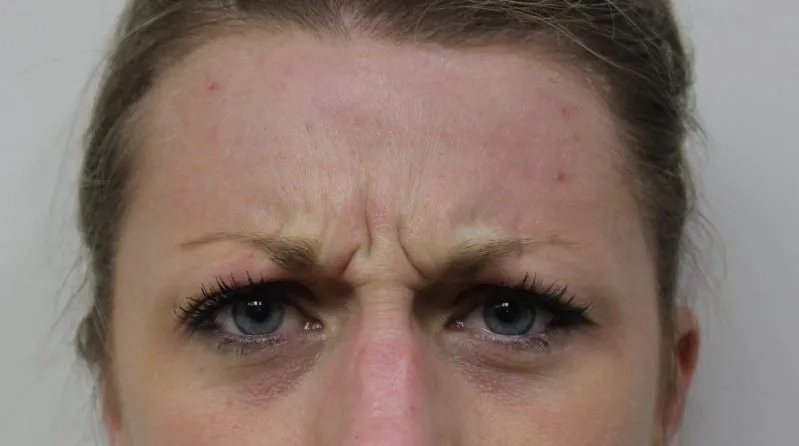 Botox & Juvederm example