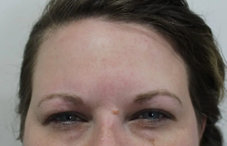 Botox & Juvederm example