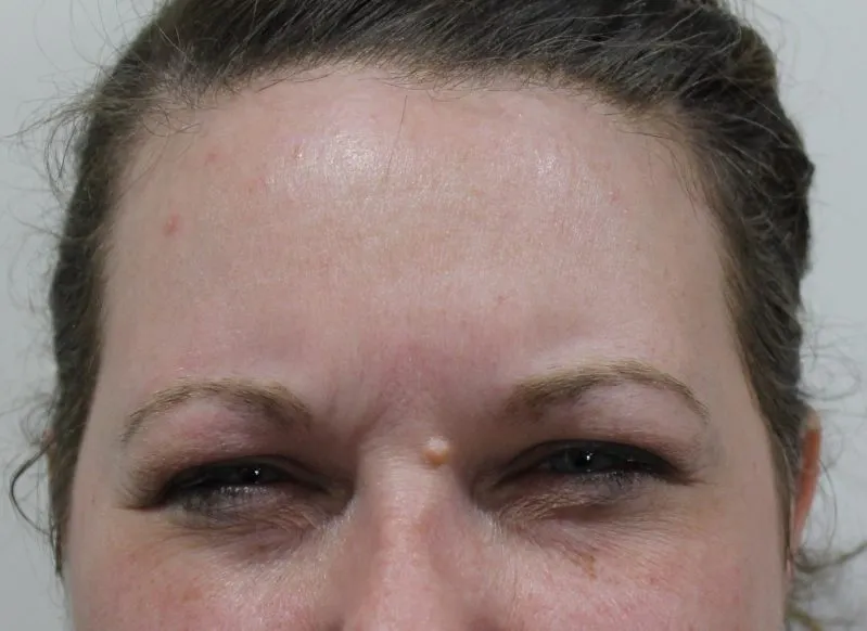 Botox & Juvederm example