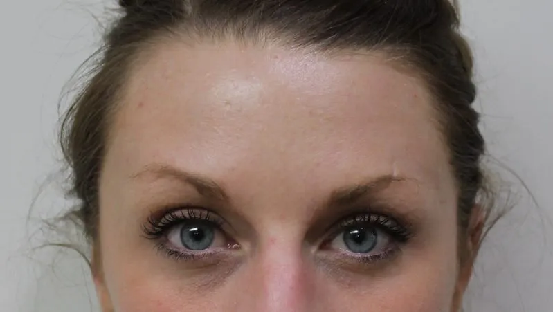 Botox & Juvederm example