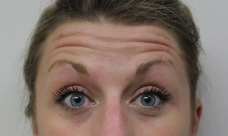 Botox & Juvederm example