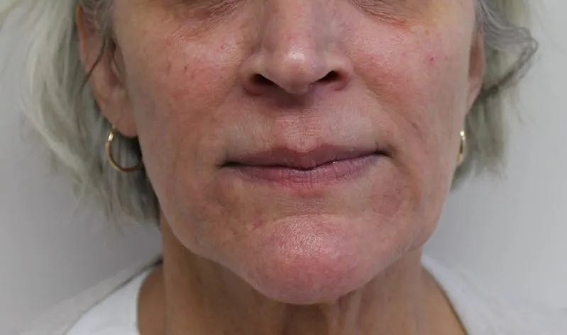 Botox & Juvederm example