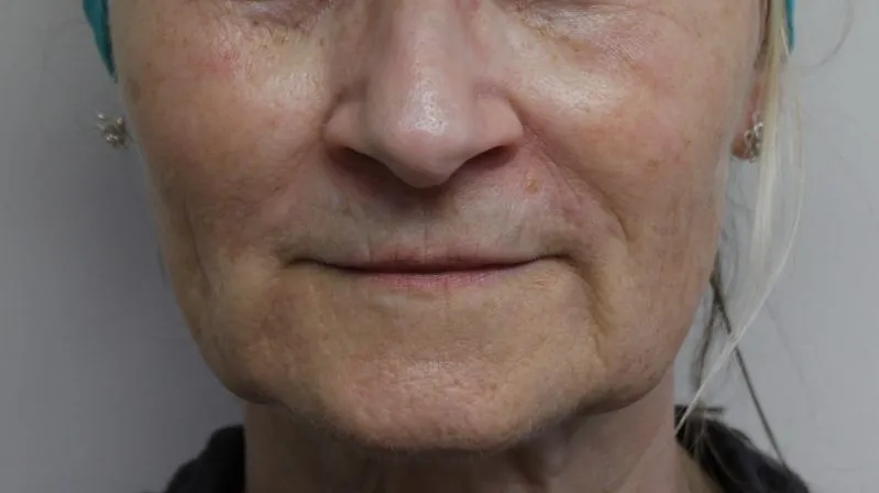 Botox & Juvederm example