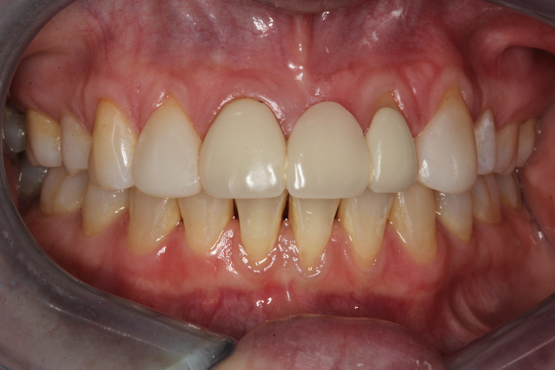 After Composite Veneers