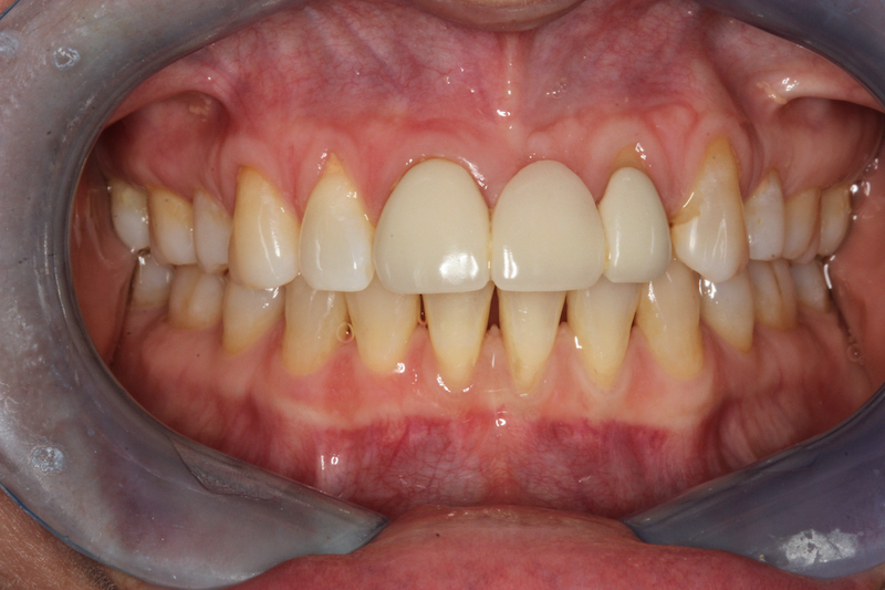 Before Composite Veneers