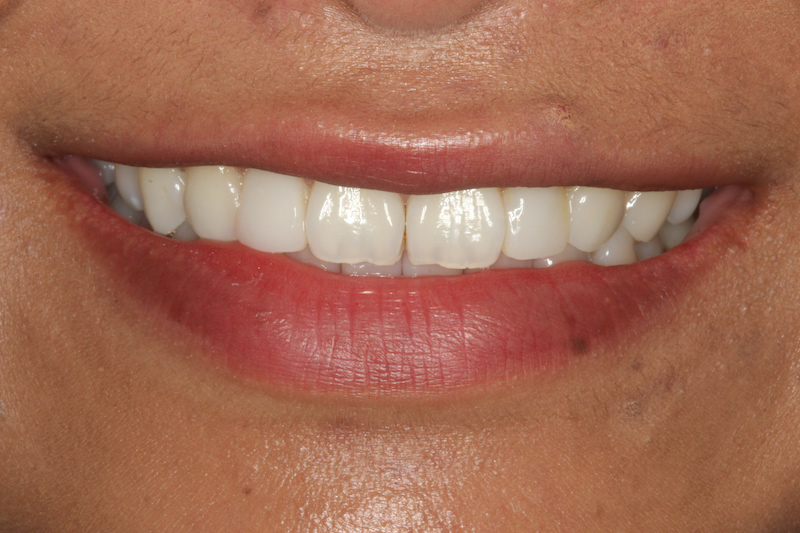 After Composite Veneers