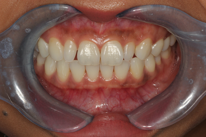 Before Composite Veneers