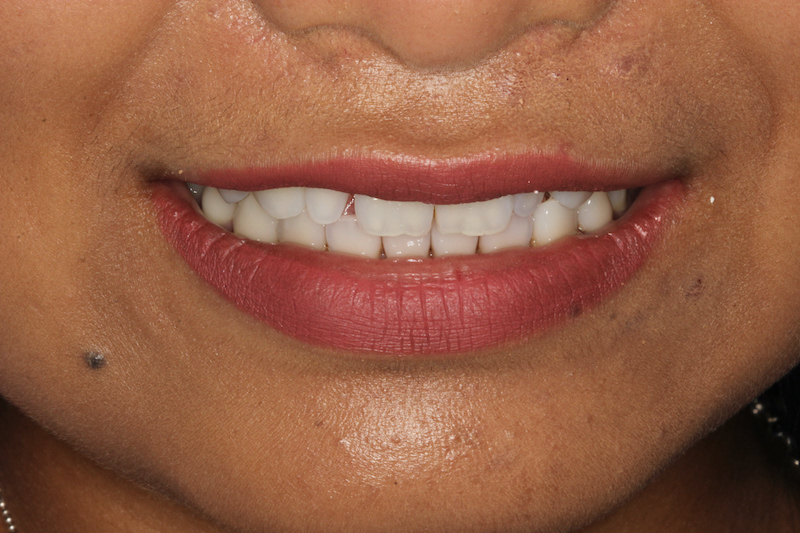 Before Composite Veneers