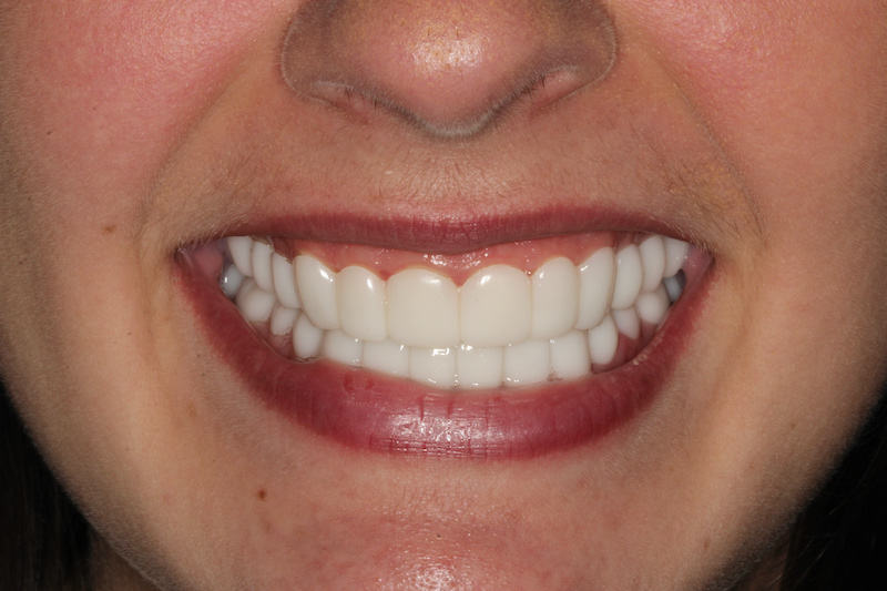 After Composite Veneers