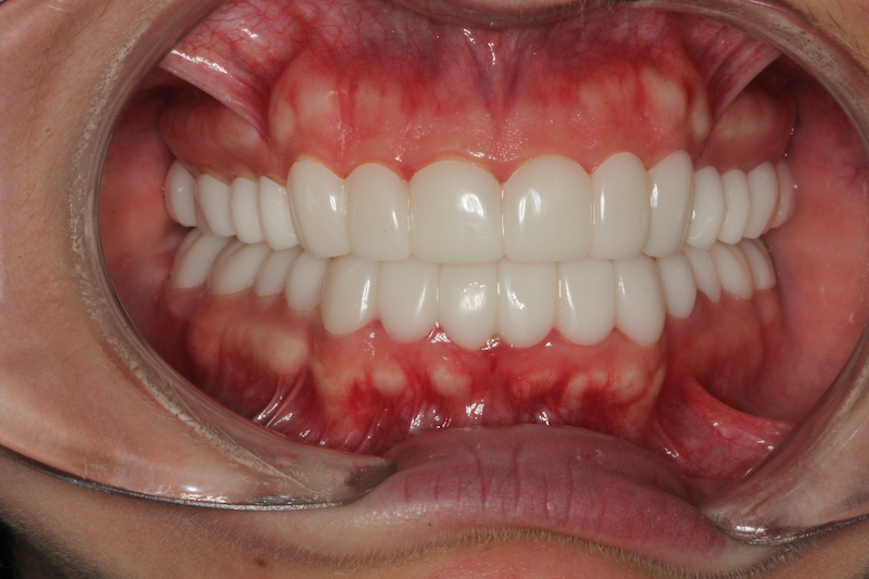 After Composite Veneers