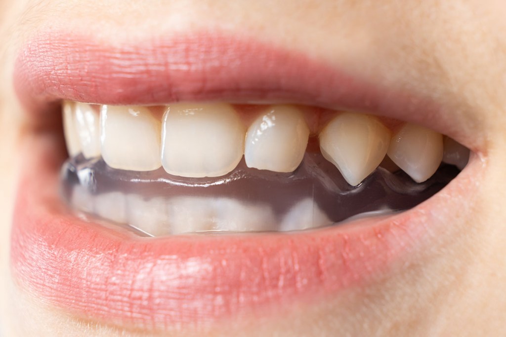 occlusal splints orthodontists dentist in Beckley WV